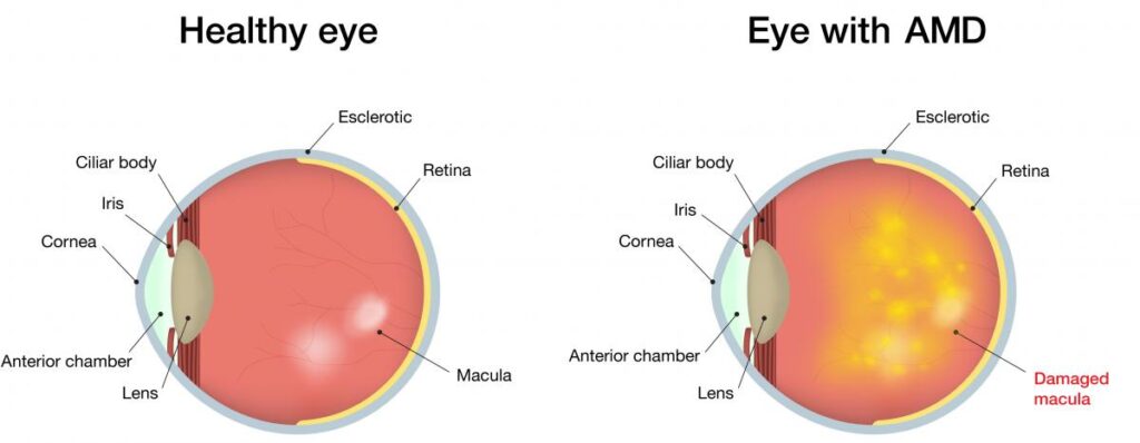 Age Related Macular Degeneration Image