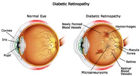 Diabetic Retinopathy Eye Disease Specialist NYC