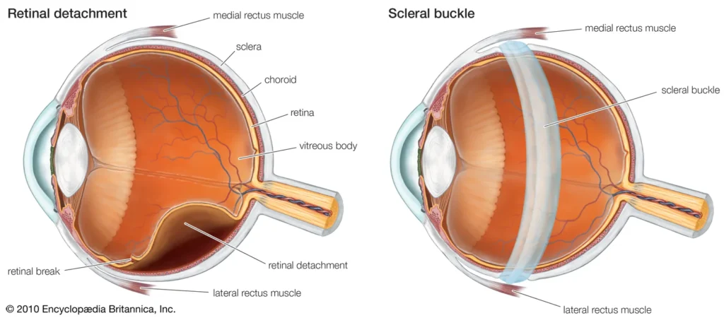 Retinal Detachment 1